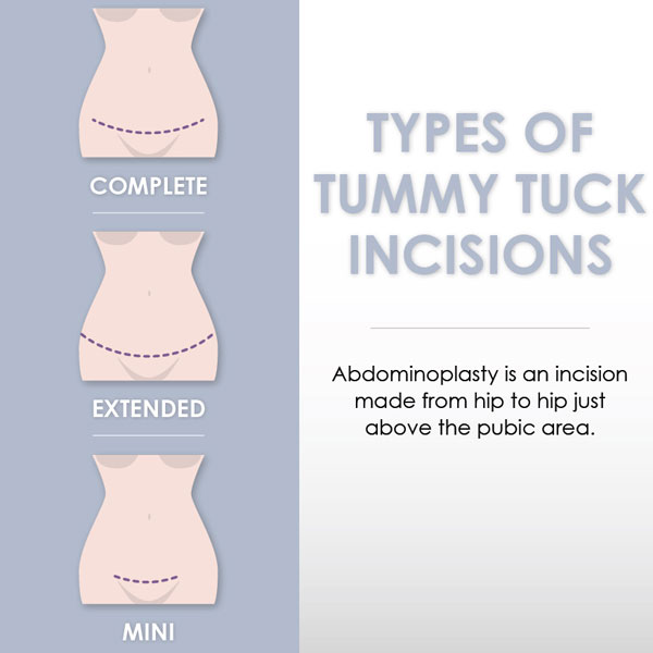 Types of tummy tuck 