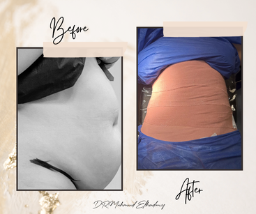 عمليات شد البطن