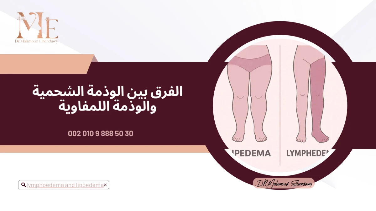 الفرق بين الوذمة الشحمية والوذمة اللمفاوية