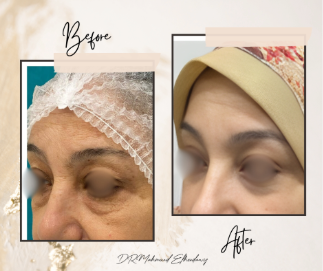 شد الجفن السفلي