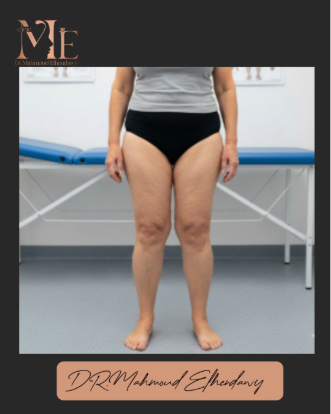 الوذمة الشحمية