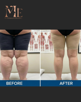 الوذمة الشحمية