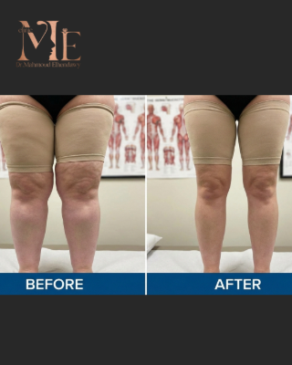 الوذمة الشحمية