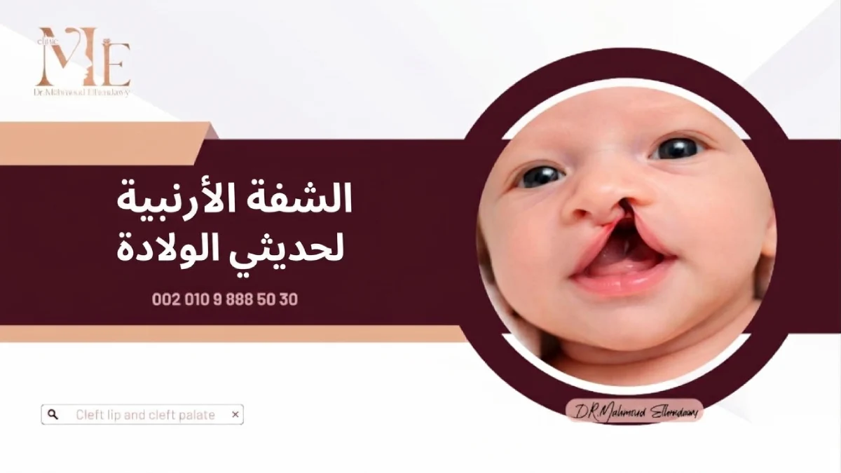 الشفة الأرنبية لحديثي الولادة