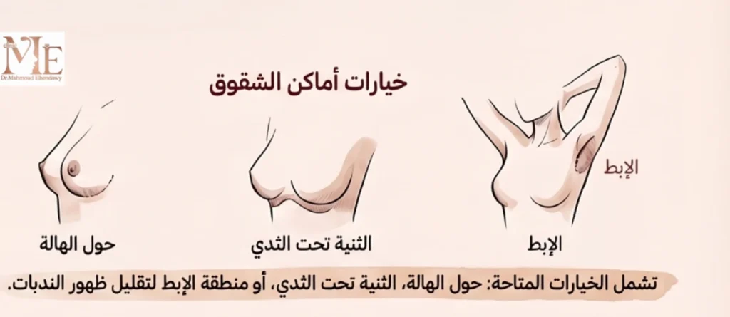 حشوات السيليكون للصدر