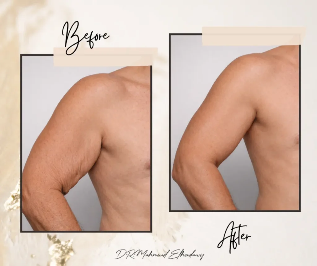 عملية شد الذراعين