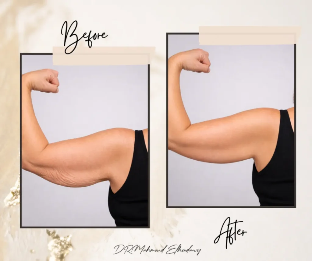 عملية شد الذراعين