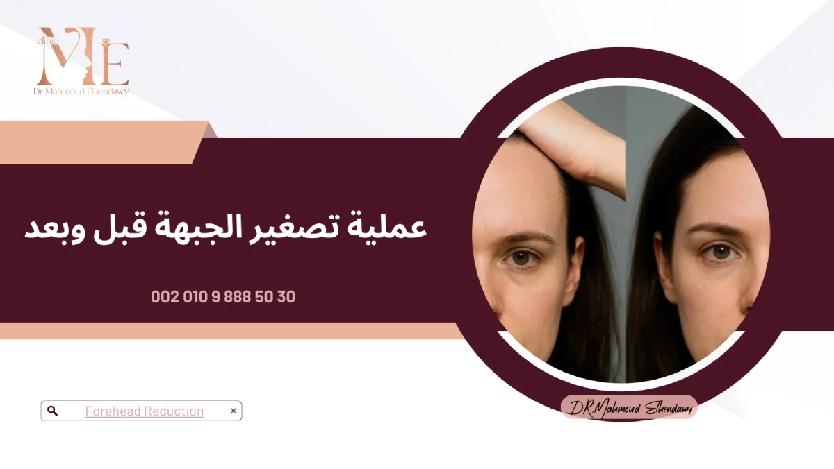 عملية تصغير الجبهة قبل وبعد