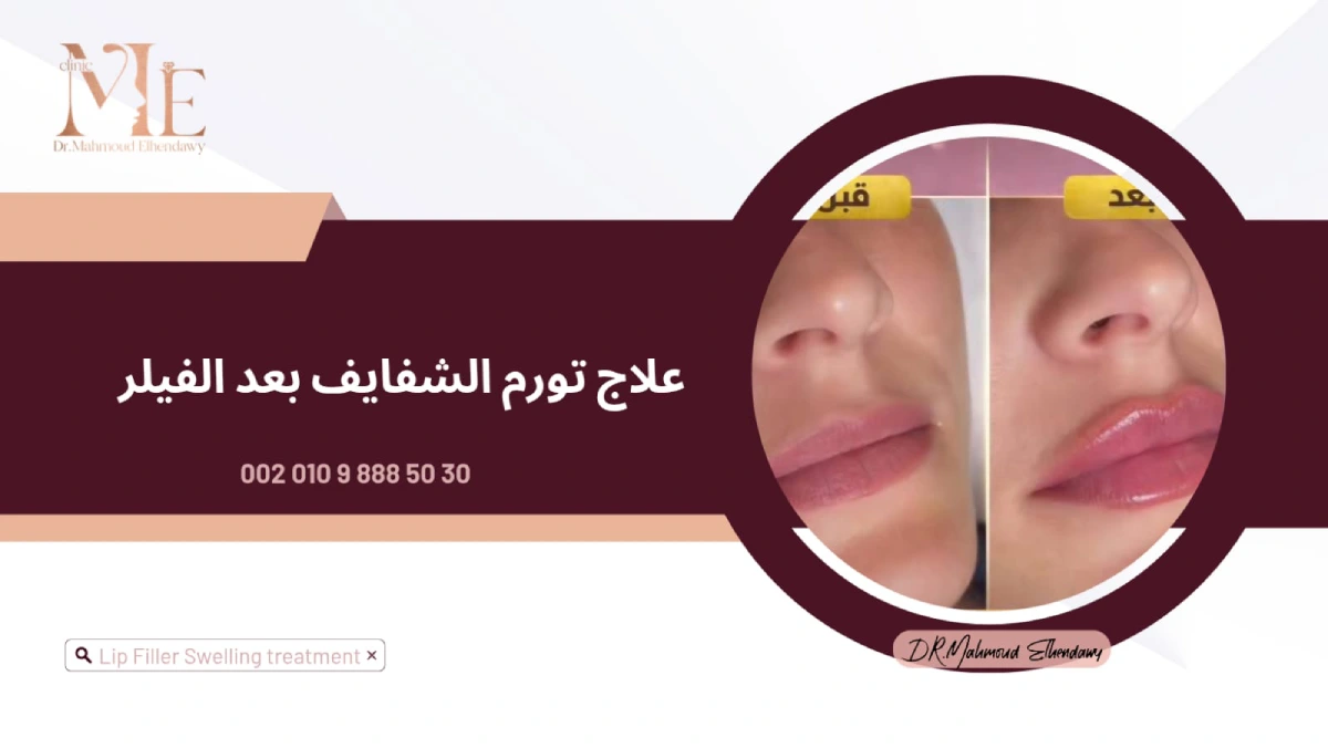 علاج تورم الشفايف بعد الفيلر