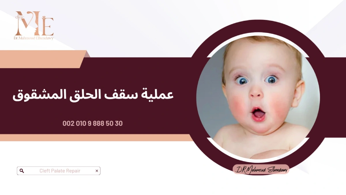 عملية سقف الحلق المشقوق