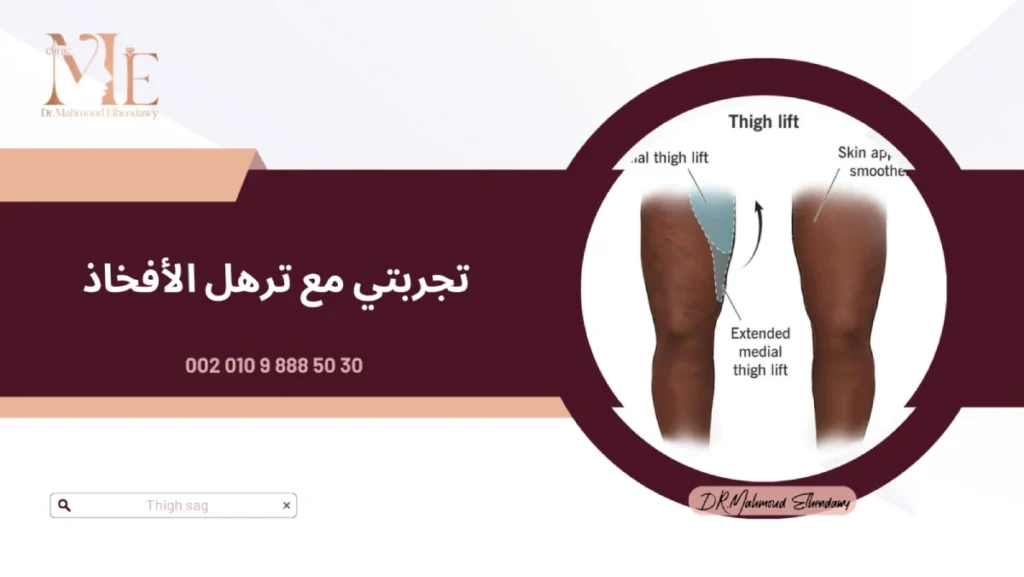 تجربتي مع ترهل الأفخاذ