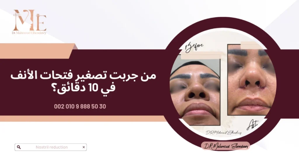 إجراء تصغير فتحات الأنف في 10 دقائق