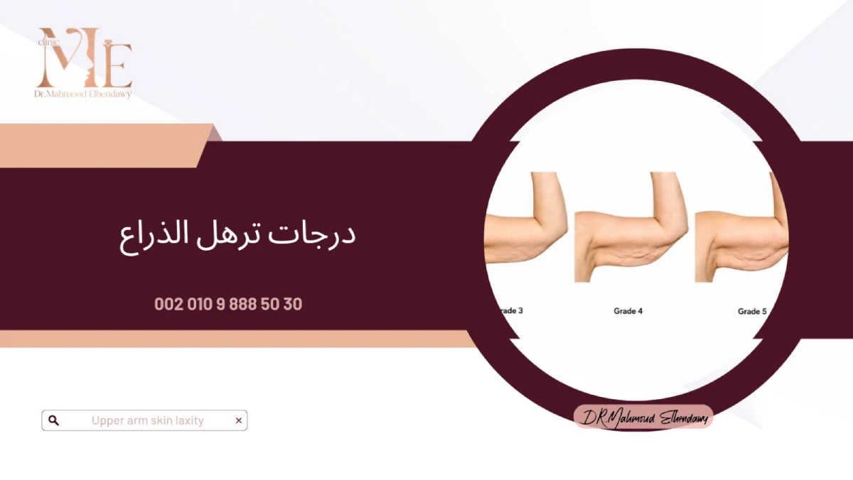 درجات ترهل الذراع