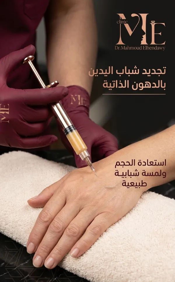 حقن اليدين بالدهون الذاتية