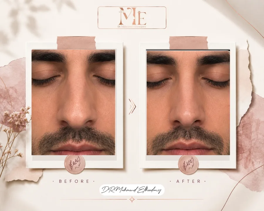 عملية تجميل الأنف اللحمي قبل وبعد
